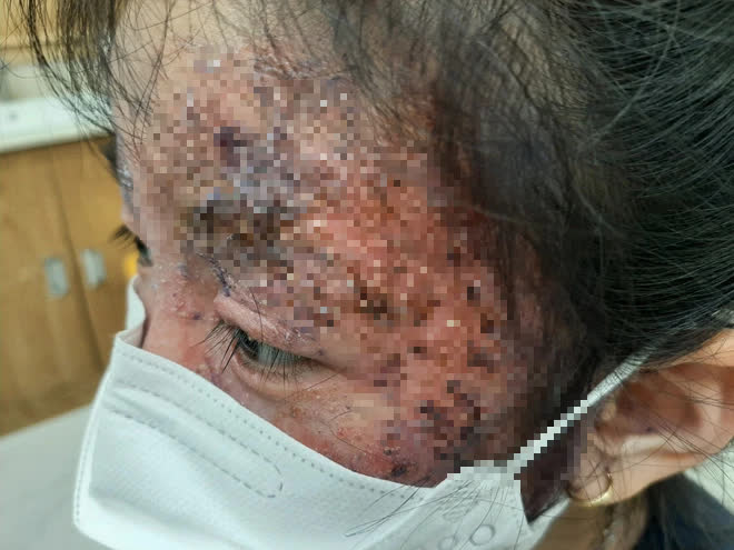 Dùng thuốc trị nấm sai cách, bé gái 8 tuổi bị tổn thương da nghiêm trọng - Ảnh 1.