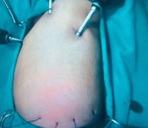 Kỳ tích cứu sống hai bé sơ sinh 1 ngày tuổi có ruột non, ruột già chạy lên lồng ngực - Ảnh 1. Kỳ tích cứu sống hai bé sơ sinh 1 ngày tuổi có ruột non, ruột già chạy lên lồng ngực - Ảnh 1.