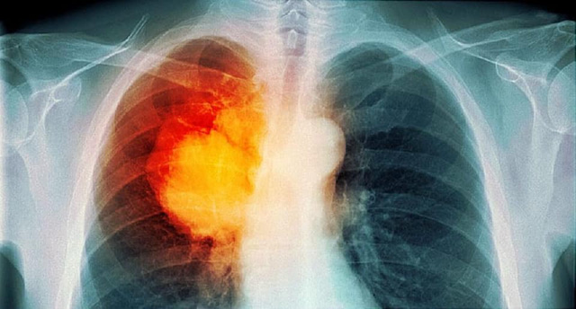 Mắc ung thư phổi: Tiên lượng sống và điều trị thế nào? - Ảnh 1.