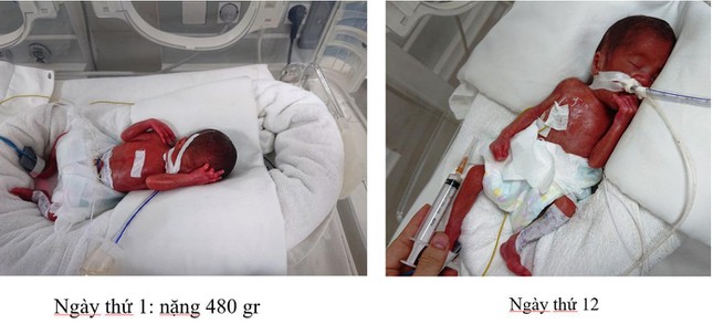 Cứu sống bé sơ sinh cực non ở Phú Thọ chỉ nặng chưa đầy nửa cân - Ảnh 2.