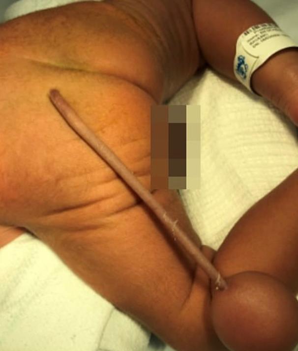 Kỳ lạ em bé ở Brazil sinh ra có đuôi dài 12 cm - Ảnh 1.