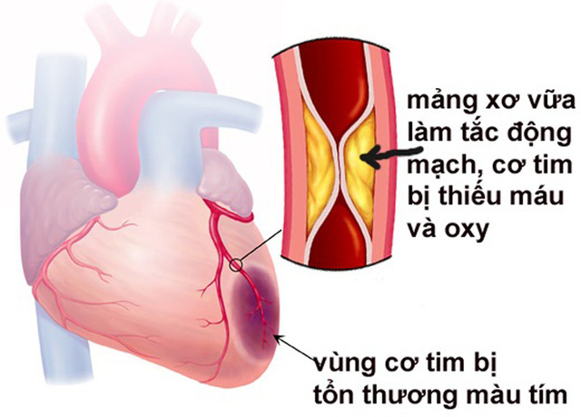 7 yếu tố nguy cơ gây bệnh tim mạch có thể phòng tránh được - Ảnh 2.