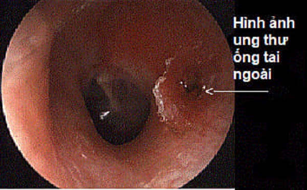 Ung thư ống tai ngoài: Đừng bỏ qua những bất thường ở tai! - Ảnh 1.