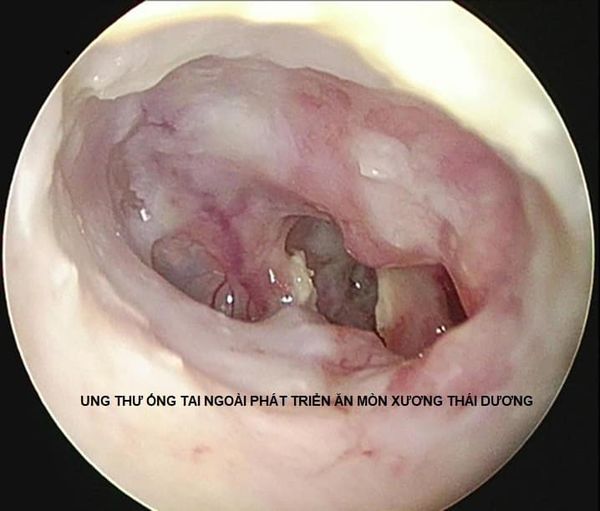 Ung thư ống tai ngoài: Đừng bỏ qua những bất thường ở tai! - Ảnh 3.