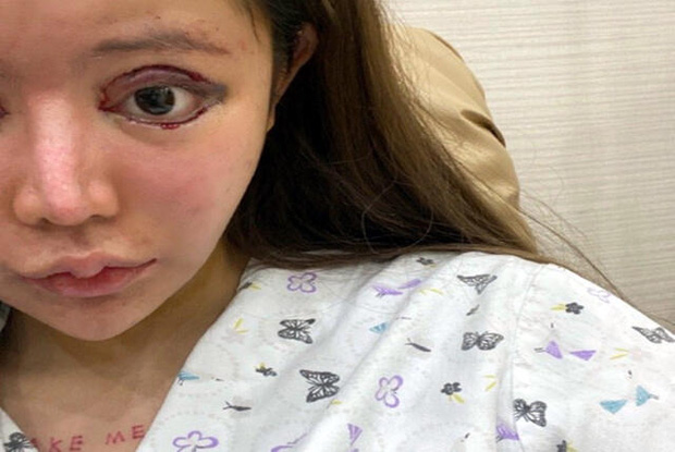 Nữ sinh chi đến 10,6 tỷ phẫu thuật thẩm mỹ, sau 3 năm trở thành người nghiện dao kéo, gương mặt hiện tại khiến ai cũng sốc - Ảnh 4.