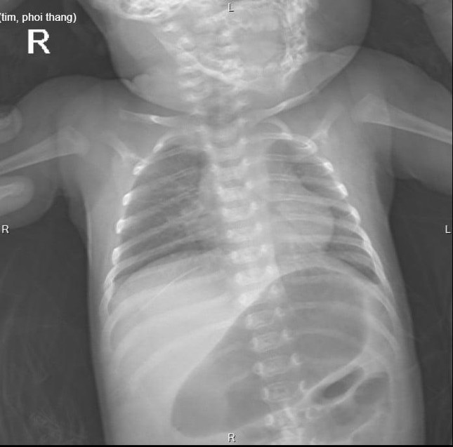 23 ngày sau khi sinh, bé gái mắc bệnh hiểm khiến toàn bộ ruột non nằm trên... phổi - Ảnh 1.