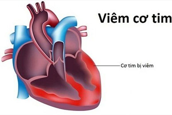 Sau tiêm vaccine phòng COVID-19: Có nên tập luyện thể dục thể thao? - Ảnh 2.