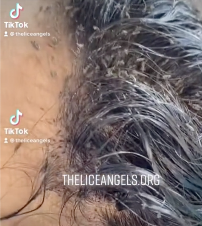 Tới salon với mái tóc lúc nhúc hàng triệu con chấy “siêu to” bò xuống cả trán, cô bé khiến chuyên gia khóc thét và cái kết ngỡ ngàng ở cuối - Ảnh 1.