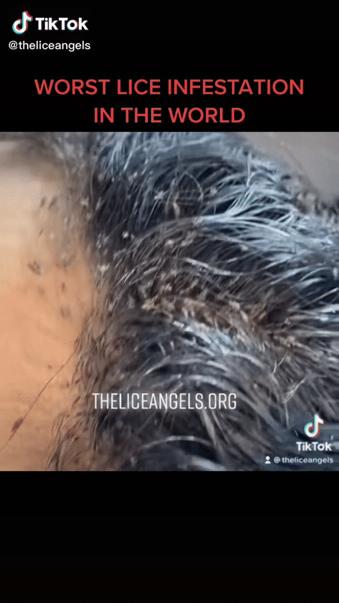 Tới salon với mái tóc lúc nhúc hàng triệu con chấy “siêu to” bò xuống cả trán, cô bé khiến chuyên gia khóc thét và cái kết ngỡ ngàng ở cuối - Ảnh 2.