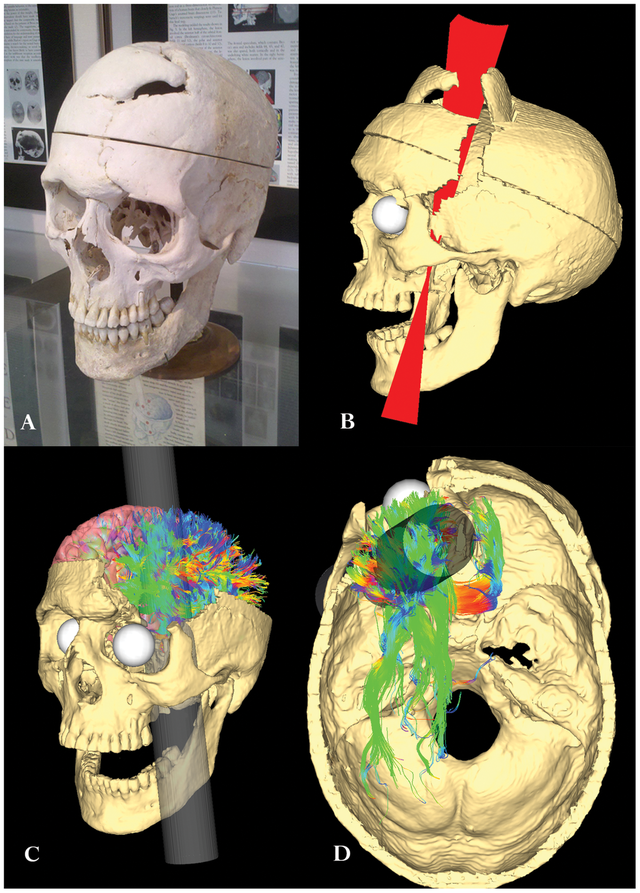  Phineas Gage và vụ tai nạn đã khai sinh ra khoa học thần kinh hiện đại  - Ảnh 4.