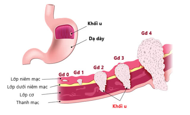 Ai dễ mắc ung thư? Các triệu chứng phát hiện sớm căn bệnh này - Ảnh 2.