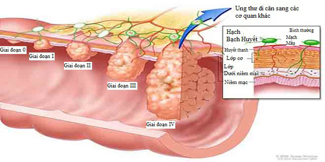 Ai dễ mắc ung thư? Các triệu chứng phát hiện sớm căn bệnh này - Ảnh 3.