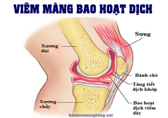 Một số nguyên nhân gây đau khớp gối - Ảnh 2.