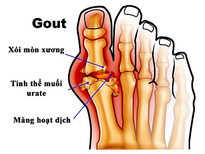 Một số nguyên nhân gây đau khớp gối - Ảnh 3.