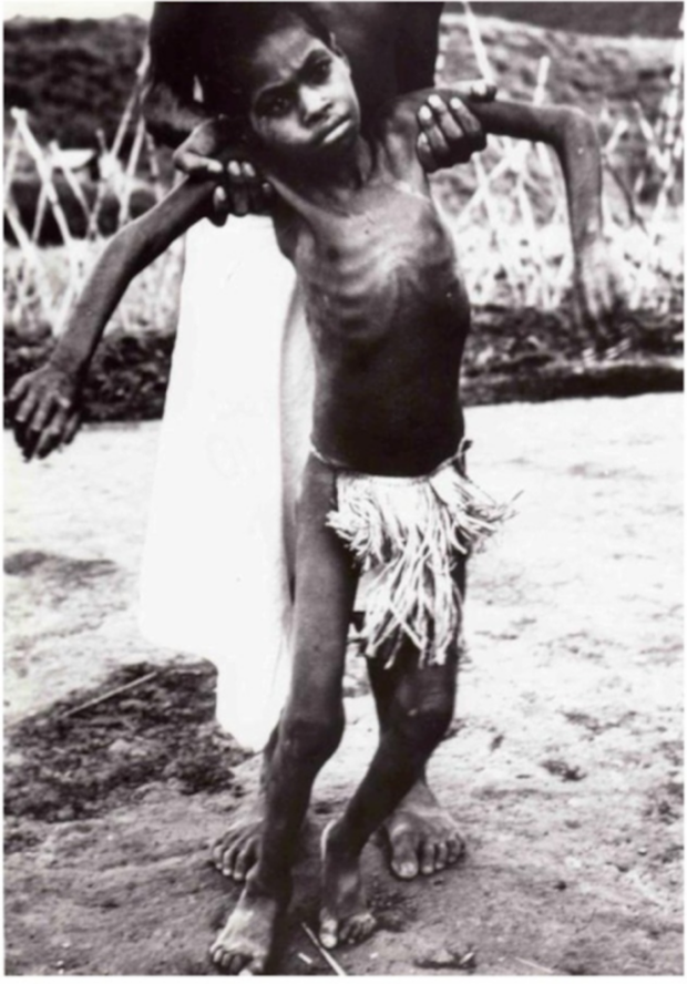 Kuru - căn bệnh lây nhiễm kỳ lạ suýt xóa sổ một bộ lạc, nguyên nhân tới từ việc... ăn thịt người - Ảnh 9.