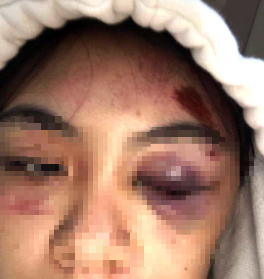  Nữ sinh bị đánh hội đồng dã man phải nhập viện cấp cứu: Xử dằn mặt vì ghen tuông!  - Ảnh 1.