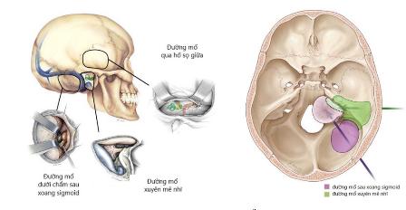 U dây thần kinh số 8: Nhận biết, nguyên nhân và cách điều trị - Ảnh 5.