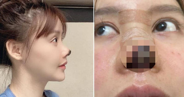 Nữ diễn viên Trung Quốc phẫu thuật thẩm mỹ tới nỗi rụng cả mũi, ngượng không dám thò mặt ra đường - Ảnh 1.