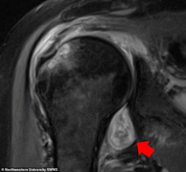 COVID-19 có khả năng gây hoại thư: Chụp MRI hé lộ điều đáng sợ COVID-19 làm với cơ thể - Ảnh 6. COVID-19 có khả năng gây hoại thư: Chụp MRI hé lộ điều đáng sợ COVID-19 làm với cơ thể - Ảnh 6.