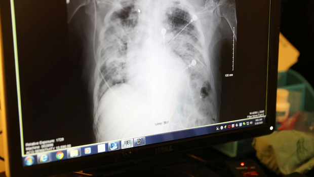 Bệnh nhân Mỹ tử vong sau khi được ghép phổi của người nhiễm virus SARS-CoV-2 - Ảnh 1.
