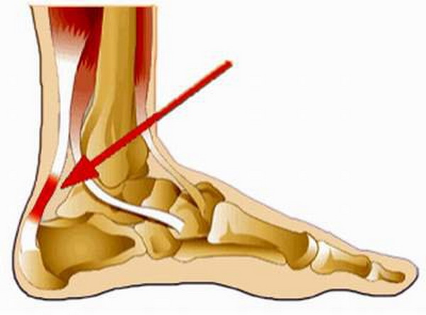Viêm gân Achilles khi chơi thể thao: Chấn thương dễ gặp - Ảnh 2.