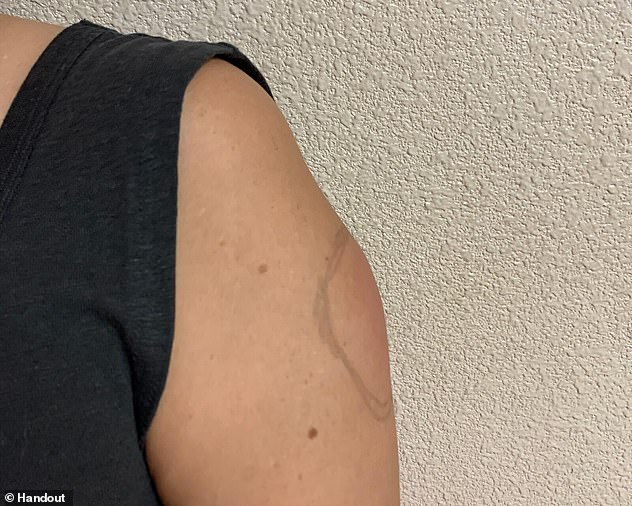 Cánh tay sưng to như quả bóng chày sau khi tiêm vắc xin COVID-19: Bác sĩ nói gì? - Ảnh 1. Cánh tay sưng to như quả bóng chày sau khi tiêm vắc xin COVID-19: Bác sĩ nói gì? - Ảnh 1.