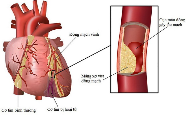 Dấu hiệu nhận biết bệnh tim mạch - Ảnh 1.