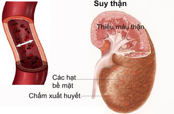 Dấu hiệu nhận biết chức năng thận suy giảm - Ảnh 1.