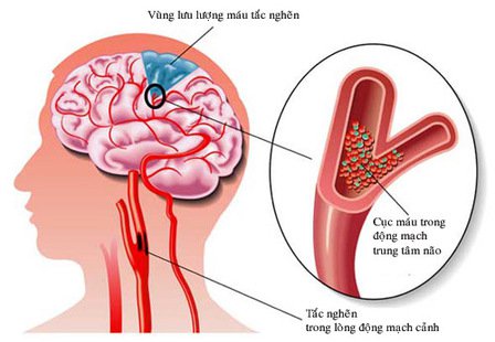 Phòng ngừa đột quỵ như thế nào? - Ảnh 2.