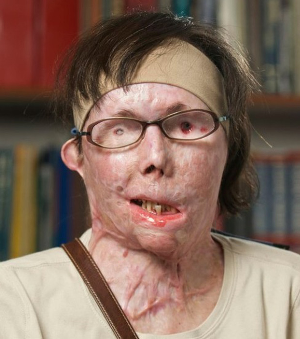 Bị chồng cũ tạt axit hủy hoại gương mặt thành quái vật, người phụ nữ được phẫu thuật ghép mặt từ người chết cho kết quả đầy ngỡ ngàng - Ảnh 4.