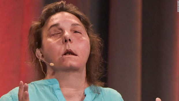 Bị chồng cũ tạt axit hủy hoại gương mặt thành quái vật, người phụ nữ được phẫu thuật ghép mặt từ người chết cho kết quả đầy ngỡ ngàng - Ảnh 5.