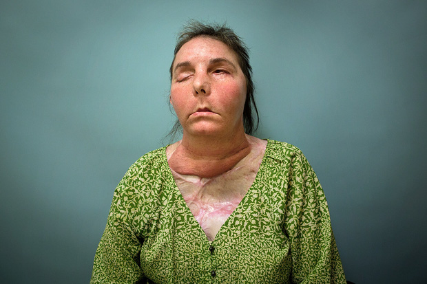 Bị chồng cũ tạt axit hủy hoại gương mặt thành quái vật, người phụ nữ được phẫu thuật ghép mặt từ người chết cho kết quả đầy ngỡ ngàng - Ảnh 6.