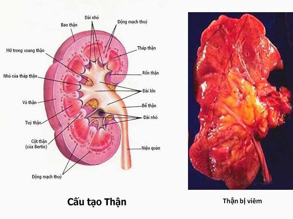 Dấu hiệu viêm cầu thận cấp - Ảnh 1.