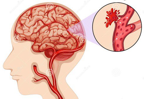 Bệnh nhân COVID -19 đối mặt với nguy cơ đột quỵ cao hơn - Ảnh 1.