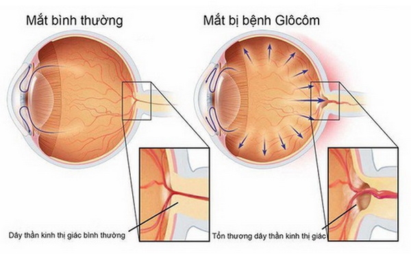 Thiên đầu thống có thể gây mù lòa  - Ảnh 1.