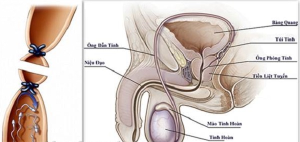  Thắt ống dẫn tinh - Biện pháp tránh thai hiệu quả, ít rủi ro  - Ảnh 2.