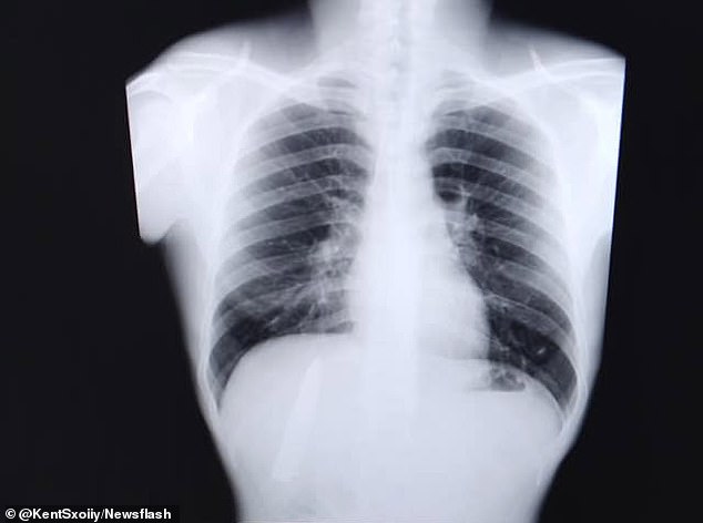 Hay đau ngực khi trời lạnh, đến lúc chụp X-quang mới thấy điều rợn người - Ảnh 2.