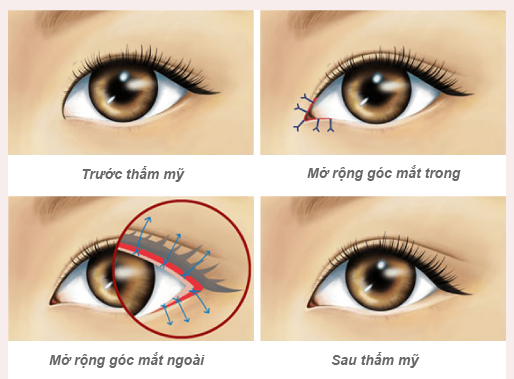 Buồn vì mắt híp liền đi mở góc mắt, không ngờ mắt bồ câu con bay con đậu - Ảnh 2.