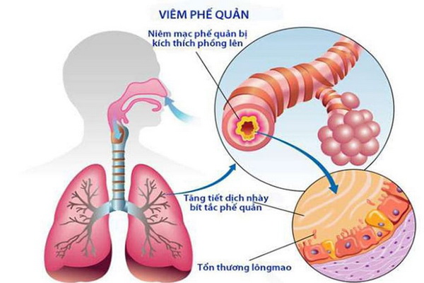 Cảnh giác biến chứng của viêm phế quản cấp - Ảnh 2.