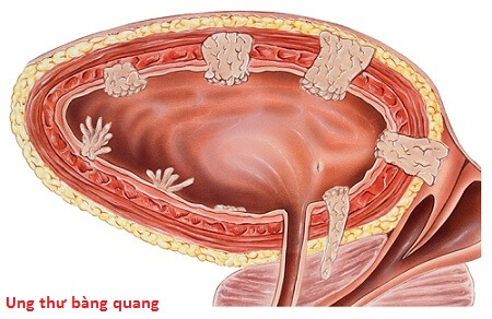 Các yếu tố nguy cơ gây ung thư bàng quang - Ảnh 1.