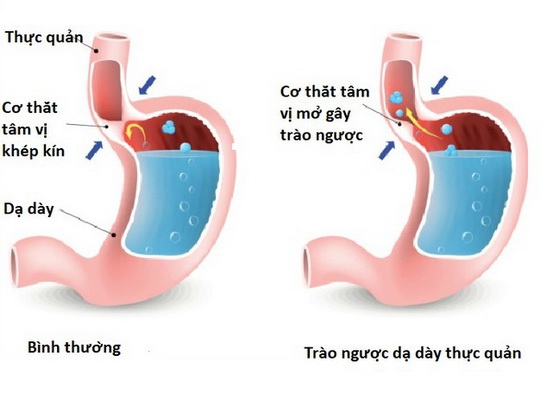 Ăn uống vội vàng, chẳng sớm thì muộn bạn cũng mắc bệnh này - Ảnh 1.