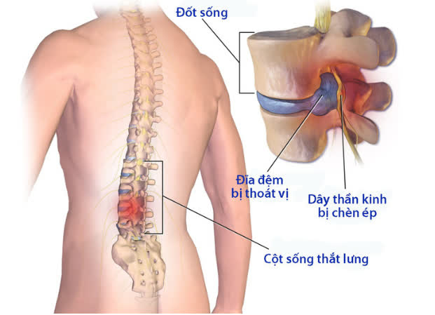 Mất hơn 100 triệu, suýt liệt sau bê chậu cây cảnh - Ảnh 1.