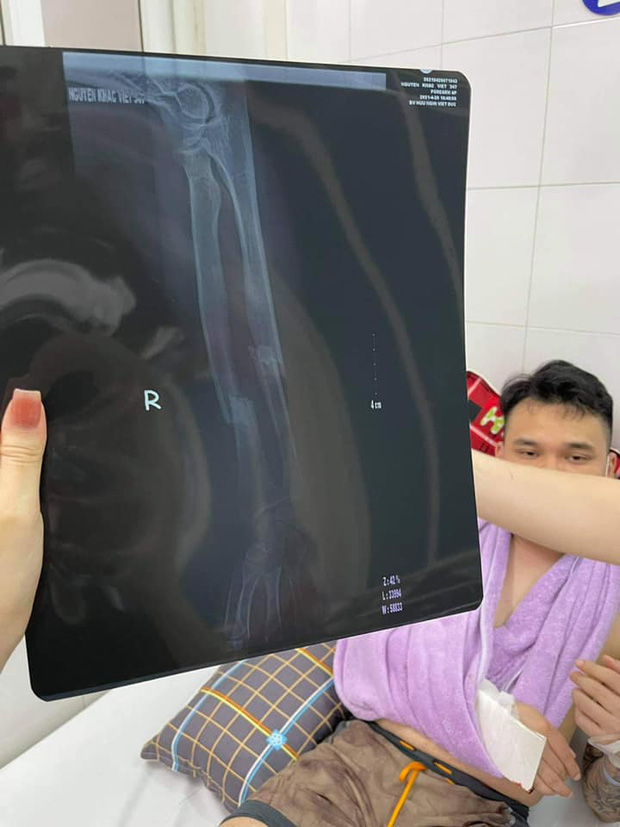 Khắc Việt nhập viện cấp cứu vì gãy tay, tạm thời cầm máu và bó nẹp chờ lên bàn mổ - Ảnh 2.