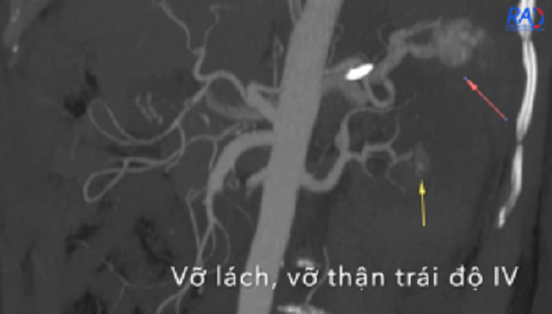 Ngã từ mái nhà, cụ ông 73 tuổi vỡ lách, vỡ thận  - Ảnh 2.