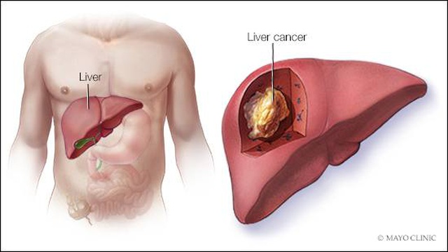 Đây là 4 lý do khiến bạn dễ bị ung thư gan: Cách phòng ngừa hiệu quả thật sự không khó - Ảnh 4. Đây là 4 lý do khiến bạn dễ bị ung thư gan: Cách phòng ngừa hiệu quả thật sự không khó - Ảnh 4.