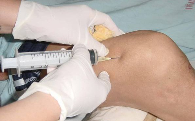 Sưng đau khớp gối đến phòng khám tư tiêm thuốc, cụ ông bị suy hô hấp - Ảnh 1. Sưng đau khớp gối đến phòng khám tư tiêm thuốc, cụ ông bị suy hô hấp - Ảnh 1.