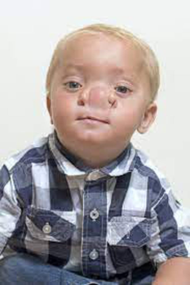 Cậu bé Pinocchio đời thực” sinh ra với chiếc mũi to dị dạng khiến bố mẹ cũng sốc, gây bất ngờ với diện mạo sau ít năm - Ảnh 12.