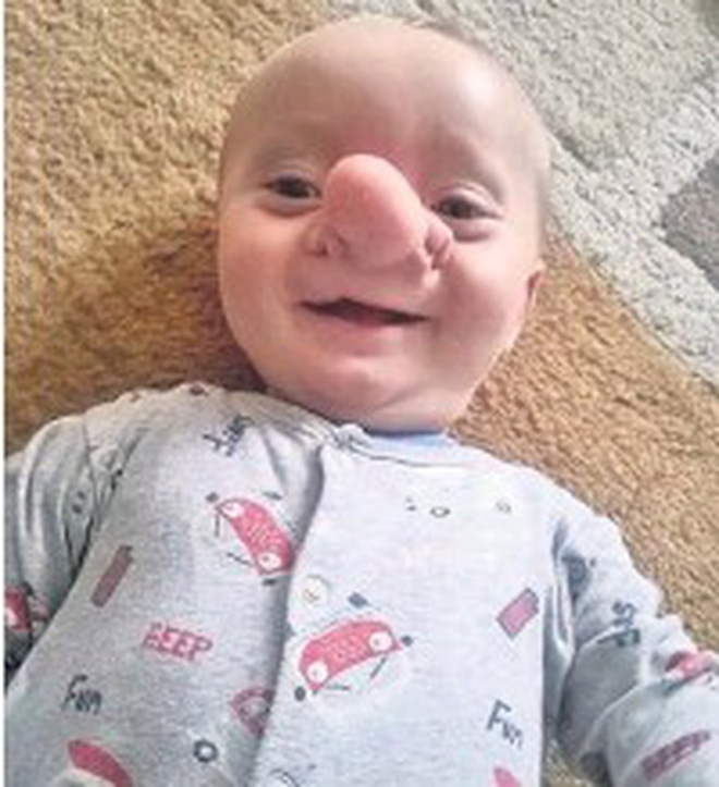 Cậu bé Pinocchio đời thực” sinh ra với chiếc mũi to dị dạng khiến bố mẹ cũng sốc, gây bất ngờ với diện mạo sau ít năm - Ảnh 5.