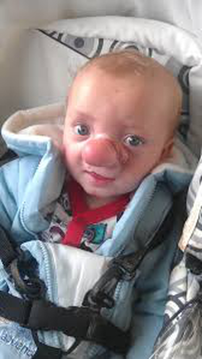 Cậu bé Pinocchio đời thực” sinh ra với chiếc mũi to dị dạng khiến bố mẹ cũng sốc, gây bất ngờ với diện mạo sau ít năm - Ảnh 6.