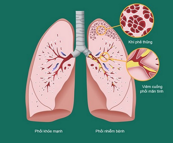 Tìm ra căn nguyên gây bệnh viêm đường hô hấp mạn tính - Ảnh 1.